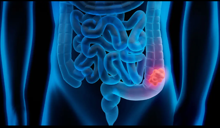 Safran Immuntherapie Darmkrebs – grafische Darstellung von IL-17-Signalweg und Tumorzellen